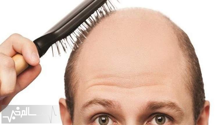 علت تضعیف ریشه مو، راهکار تعویق طاسی آقایان