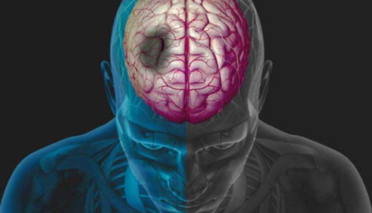 سکته مغزی تا سه ساعت قابل درمان است