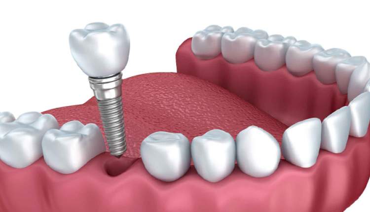 راهکار محققان دانشگاه امیرکبیر در بهبود عملکرد ایمپلنت دندانی