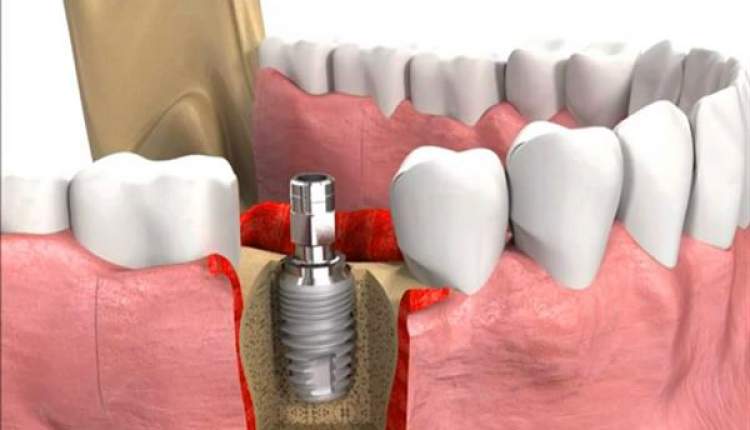 عوارض درمان نادرست ایمپلنت