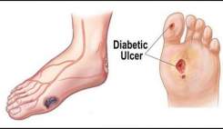 درمان زخم پای دیابتی در 21 روز
