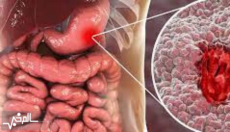 ایران در ابتلاء به سرطان معده و روده مقام اول جهان است!
