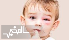  آلرژی یکی از بیماری‌های شایع کودکان است