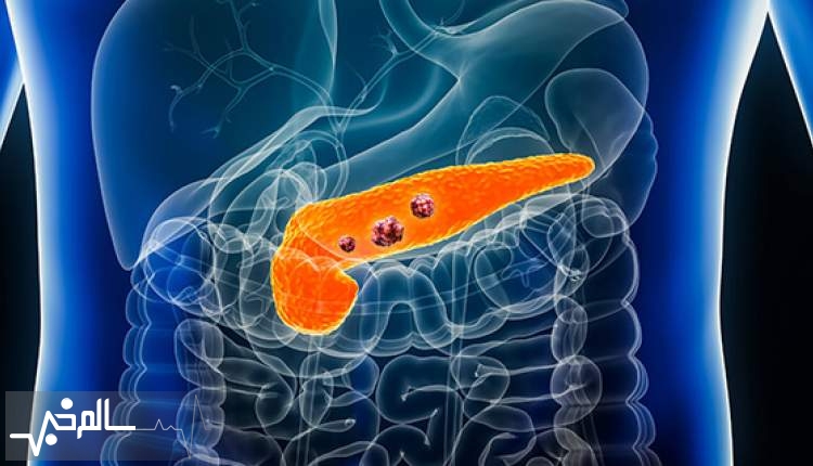 تست خون جدید با دقت 85 درصد سرطان پانکراس را در مراحل اولیه شناسایی می‌کند